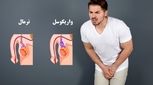 واریکوسل چیست و چه عوارضی برای کودکان و نوجوانان دارد؟