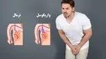 واریکوسل چیست و چه عوارضی برای کودکان و نوجوانان دارد؟