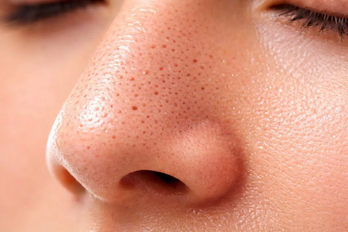 چگونه منافذ باز بینی را از بین ببریم؟ مؤثرترین روش‌های خانگی و پزشکی