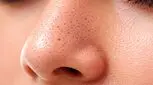 چگونه منافذ باز بینی را از بین ببریم؟ مؤثرترین روش‌های خانگی و پزشکی
