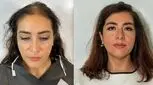 کاشت مو برای خانم‌ها توصیه نمی‌شود