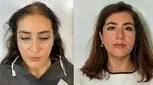 کاشت مو برای خانم‌ها توصیه نمی‌شود