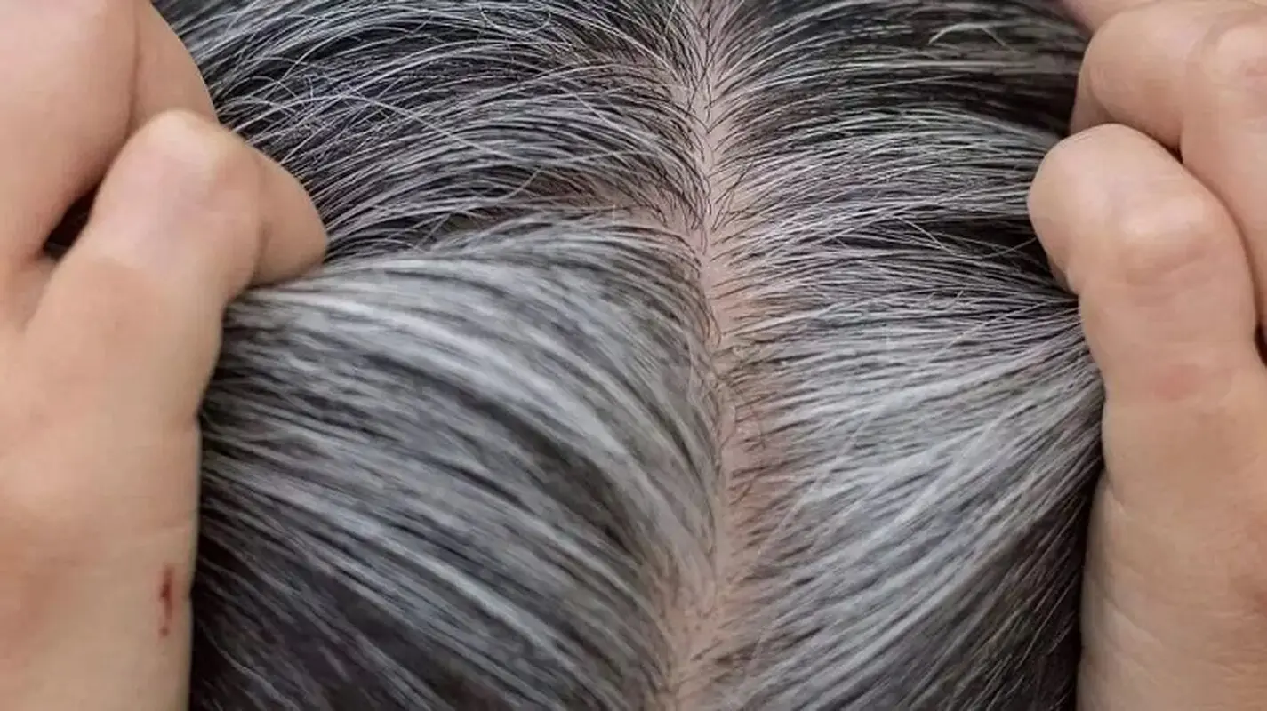 علت سفید شدن موها در جوانی چیست؟ پیشگیری از موی سفید در جوانی