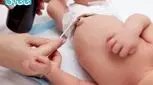 بیرون زدگی ناف نوزاد و تفاوت با فتق ناف - 6 علت + روش‌ درمان 