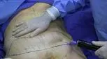 لیپوساکشن با دستگاه پال، دستیابی به نتایج بهتر