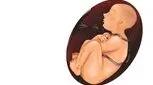 دلایل پیچیده شدن بند ناف دور گردن جنین