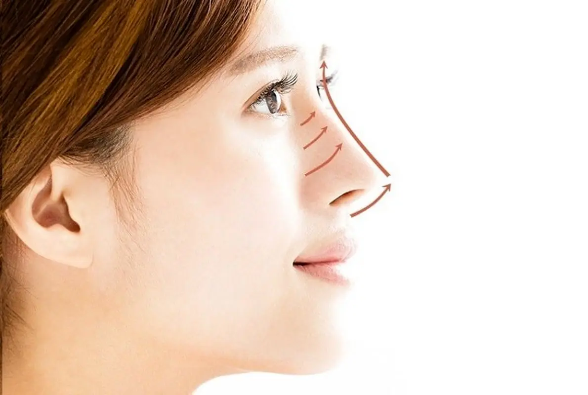  هزینه لیفت بینی در سال ۱۴۰۴ چقدر است؟