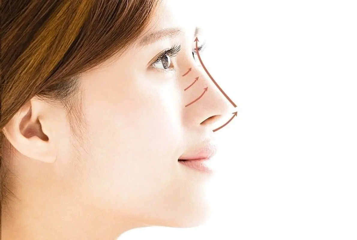  هزینه لیفت بینی در سال ۱۴۰۴ چقدر است؟