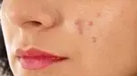با این 21 روش به جنگ جوش های صورتتان بروید!