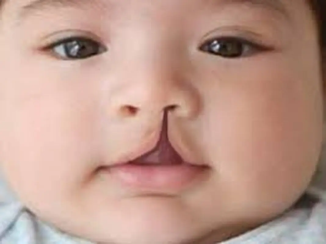 شکاف کام چیست، علل وعلائم