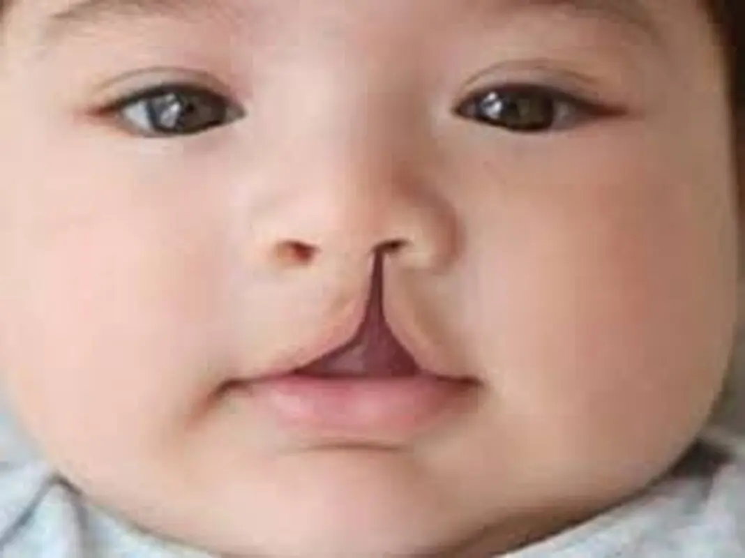 شکاف کام چیست، علل وعلائم