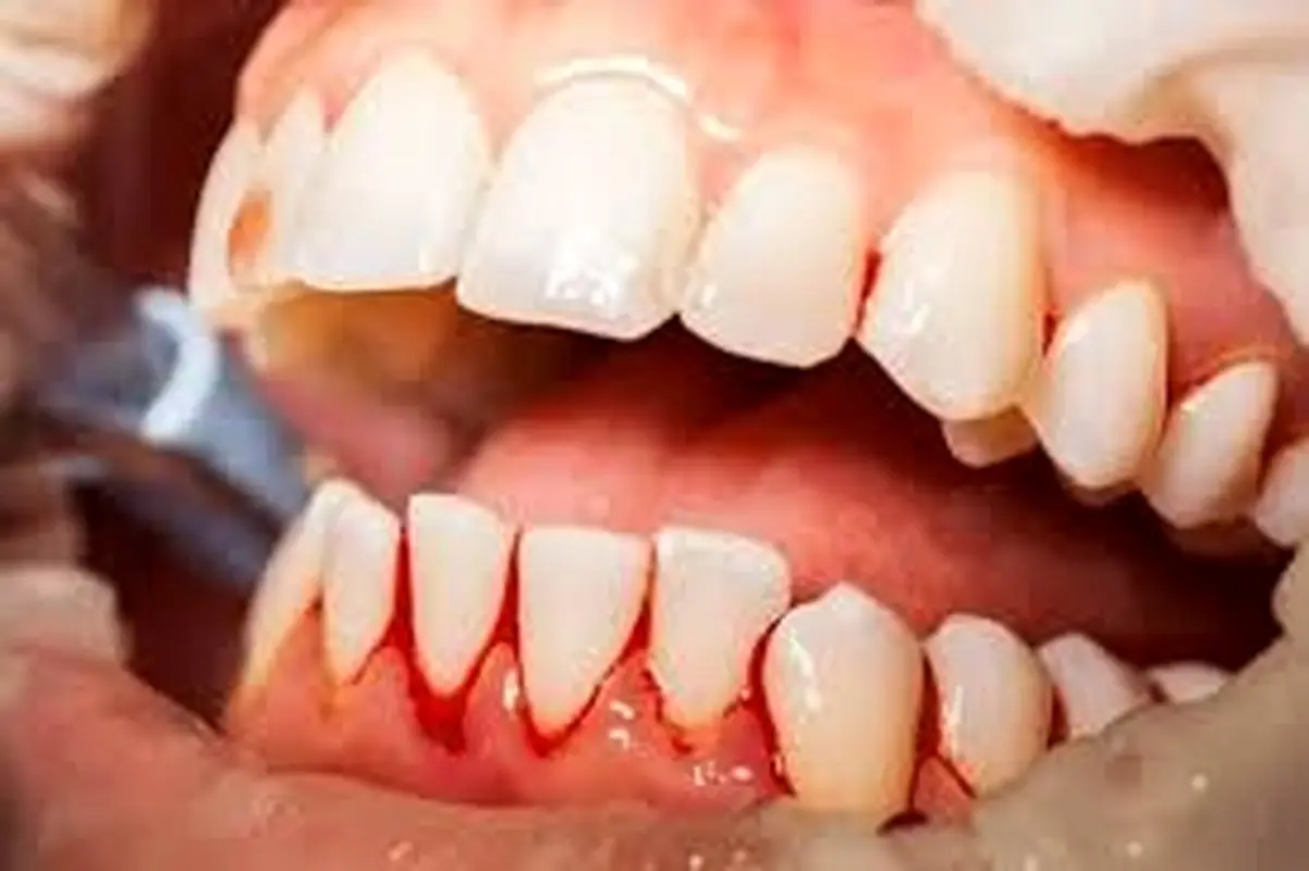 عفونت بعد از لیفت لثه