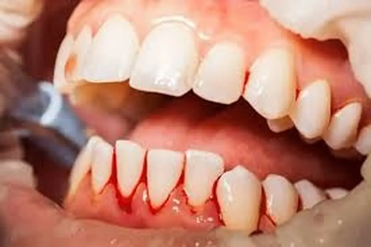 عفونت بعد از لیفت لثه