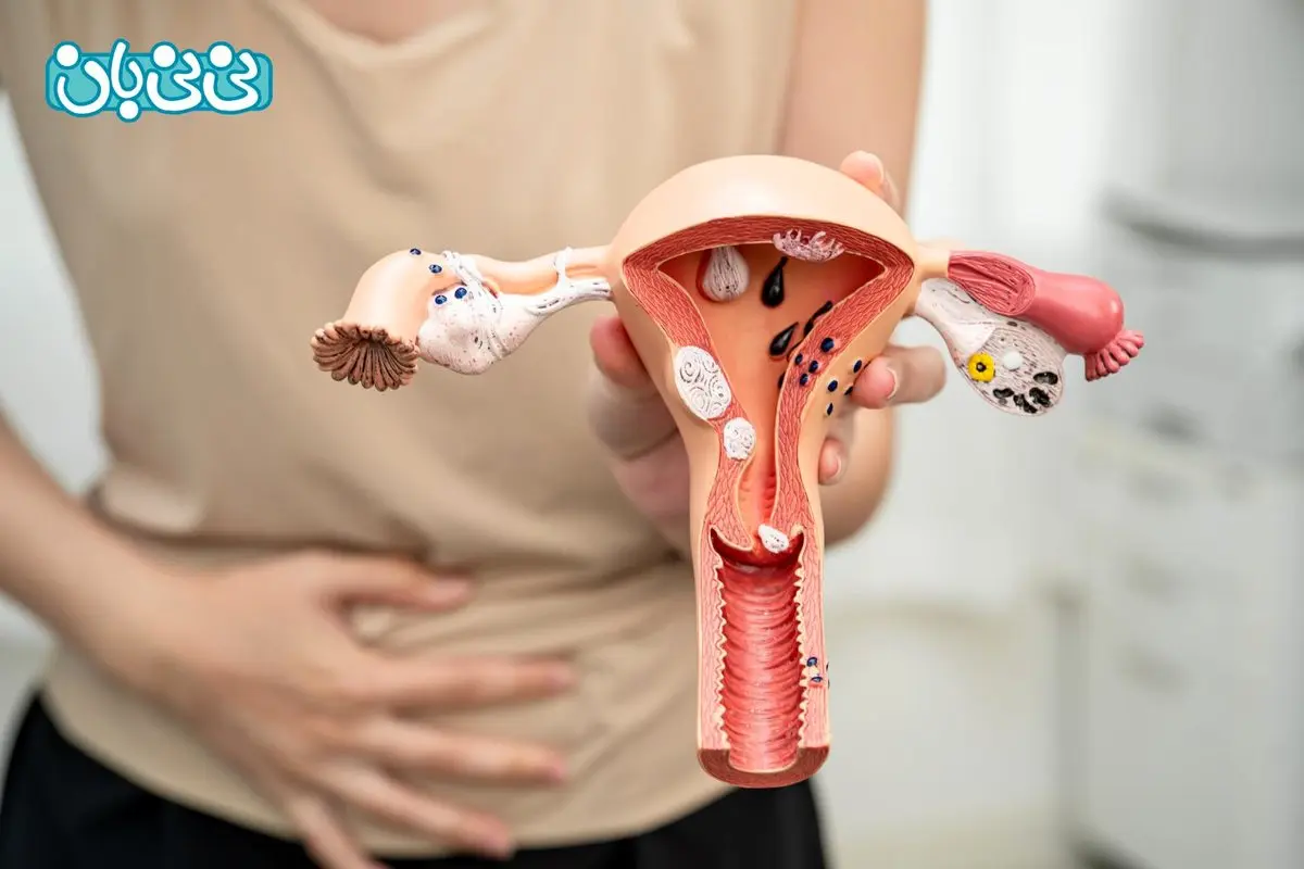 چسبندگی رحم چیست؟ 5 علت و 5 علامت شایع آن + بهترین روش درمان