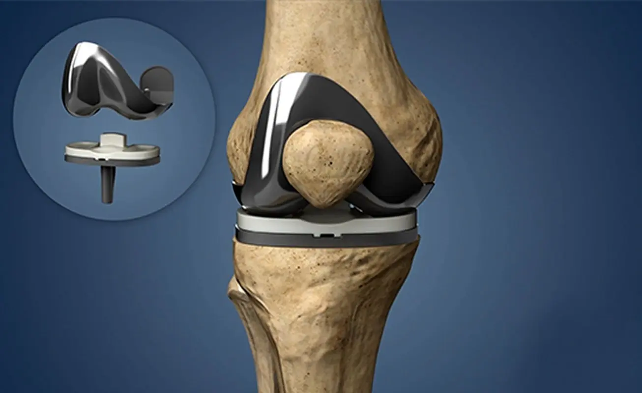 همه حقایق درباره تعویض مفصل زانو/ مفصل جدید چند سال بعد شل می‌شود؟!

