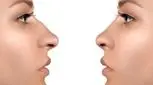 خبر خیلی خوب برای آنهایی که قوز بینی دارند!