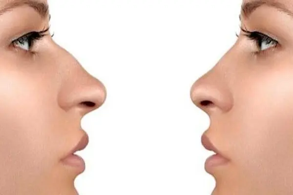 خبر خیلی خوب برای آنهایی که قوز بینی دارند!