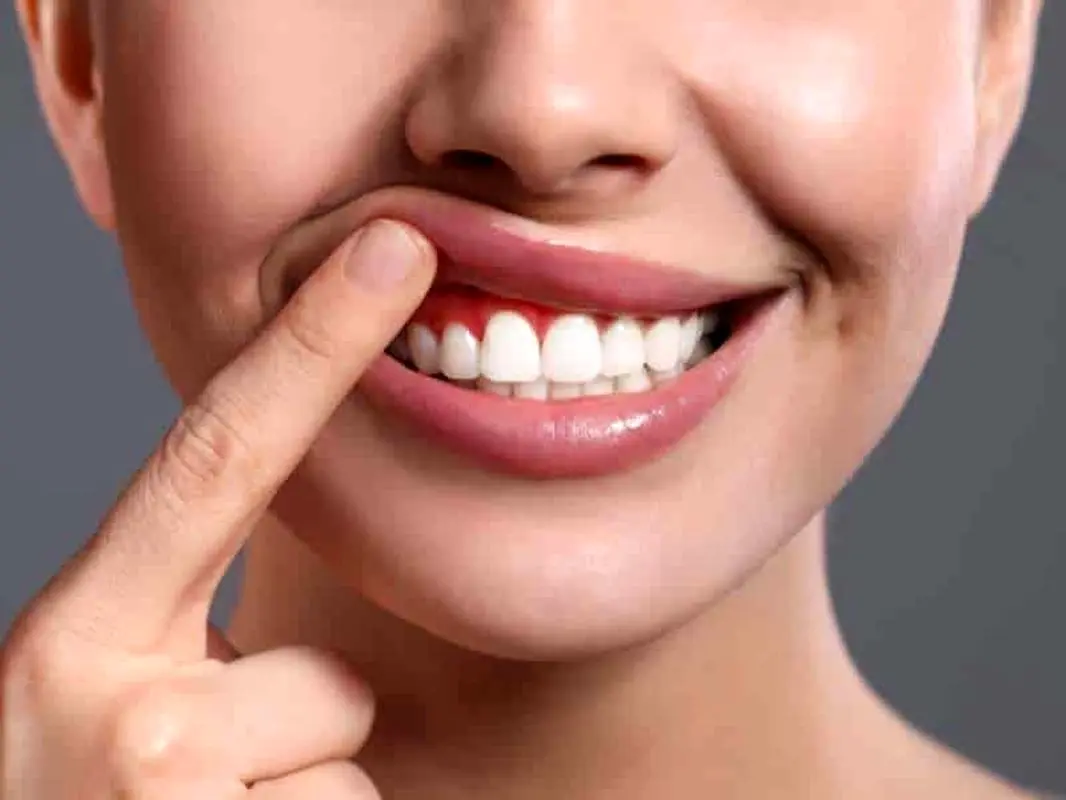 طراحی لبخند و تأثیر آن در زیبایی