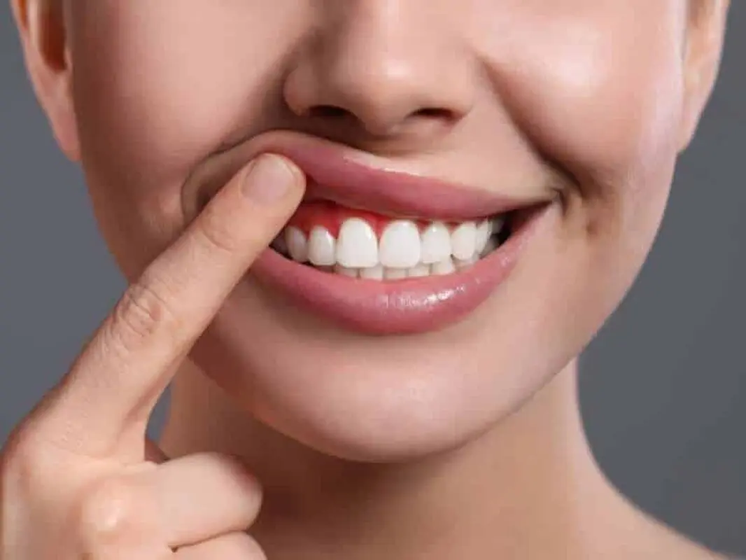 طراحی لبخند و تأثیر آن در زیبایی
