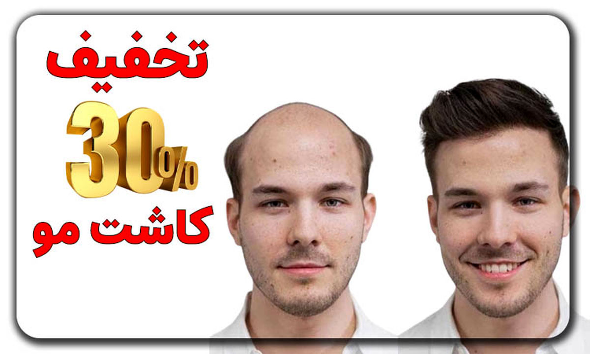 تخفیف ویژه کاشت مو | فرصتی استثنایی برای داشتن موهایی زیبا