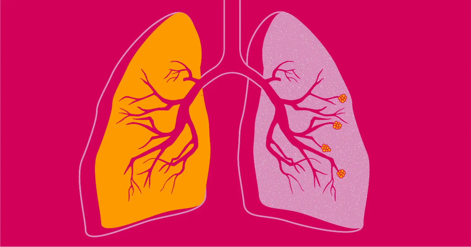 این 6 نشانه ضعف ریه را جدی بگیرید
