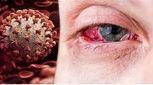 کرونا فقط ریه را درگیر نمی‌کند/ عوارض چشمی کرونا را جدی بگیرید
