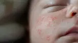جوش صورت نوزاد، چگونه از بین ببریم؟
